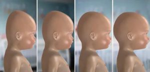 روند بهبود صاف شدن سر نوزاد 