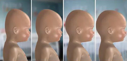بالش فرم دهی سر نوزاد ، بهترین روش برای شکل دادن سر نوزاد است